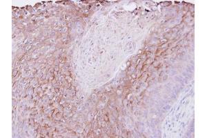 IHC-P Image Immunohistochemical analysis of paraffin-embedded Cal27 xenograft , using PIGR, antibody at 1:500 dilution. (PIGR antibody)