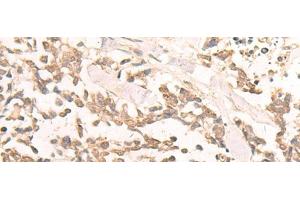 Immunohistochemistry of paraffin-embedded Human lung cancer tissue using EN2 Polyclonal Antibody at dilution of 1:30(x200) (EN2 antibody)