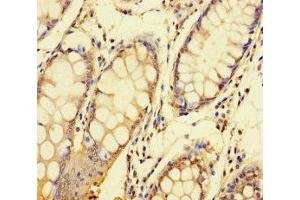 Immunohistochemistry of paraffin-embedded human colon cancer using ABIN7148417 at dilution of 1:100 (NDUFAF1 antibody  (AA 25-327))