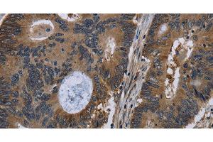 Immunohistochemistry of paraffin-embedded Human colon cancer tissue using TSC22D3 Polyclonal Antibody at dilution 1:40 (TSC22D3 antibody)