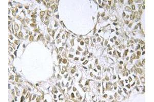 Immunohistochemistry analyzes of IKKγ antibody in paraffin-embedded human breast carcinoma tissue. (IKBKG antibody)