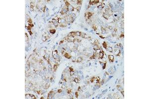 Immunohistochemistry of paraffin-embedded human liver cancer using Alkaline Phosphatase (ALPL) Rabbit pAb (ABIN3021385, ABIN3021386, ABIN1512569 and ABIN6214987) at dilution of 1:50 (40x lens). (ALPL antibody  (AA 20-270))
