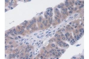 Detection of UCP2 in Human Liver cancer Tissue using Monoclonal Antibody to Mitochondrial Uncoupling Protein 2 (UCP2)