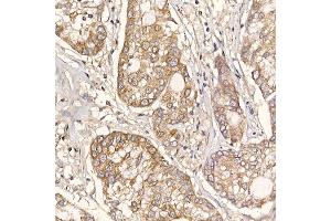 Immunohistochemistry of paraffin-embedded human lung cancer using ERp19 Rabbit mAb (ABIN7270799) at dilution of 1:200 (40x lens). (TXNDC12 antibody)