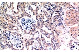 Immunohistochemistry of paraffin-embedded Human breast carcinoma tissue using Bax Monoclonal Antibody at dilution of 1:200. (BAX antibody)