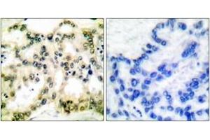 Immunohistochemistry analysis of paraffin-embedded human lung carcinoma, using Cyclin B1 (Phospho-Ser126) Antibody. (Cyclin B1 antibody  (pSer126))