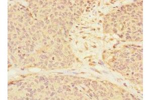 Immunohistochemistry of paraffin-embedded human ovarian cancer using ABIN7167139 at dilution of 1:100 (RASSF6 antibody  (AA 1-303))