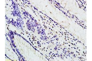 Formalin-fixed and paraffin embedded human colon carcinoma labeled with Anti-TBL1X Polyclonal Antibody, Unconjugated at 1:200 followed by conjugation to the secondary antibody and DAB staining (TBL1Y antibody  (AA 501-577))