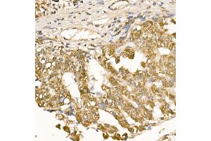 Immunohistochemistry of paraffin-embedded human liver cancer using [KO Validated] RA Rabbit pAb (ABIN3021646, ABIN3021647, ABIN3021648 and ABIN1513457) at dilution of 1:100 (40x lens). (RAB5 antibody  (AA 1-215))