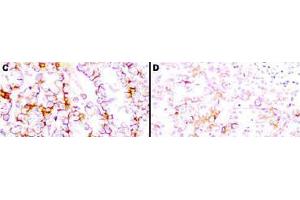 Immunohistochemistry (IHC) image for anti-Mesothelin (MSLN) (Extracellular Domain) antibody (ABIN400817) (Mesothelin antibody  (Extracellular Domain))
