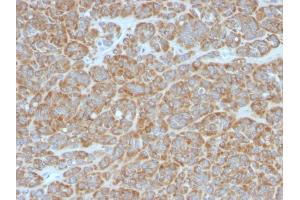 Formalin-fixed, paraffin-embedded human Melanoma stained with Bcl-2 Mouse Monoclonal Antibody (BCL2/796). (Bcl-2 antibody)
