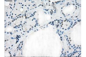 Immunohistochemical staining of paraffin-embedded Adenocarcinoma of colon tissue using anti-FCGR2A mouse monoclonal antibody.