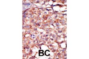 Formalin-fixed and paraffin-embedded human cancer tissue reacted with RIPK4 polyclonal antibody  , which was peroxidase-conjugated to the secondary antibody, followed by AEC staining. (RIPK4 antibody  (C-Term))