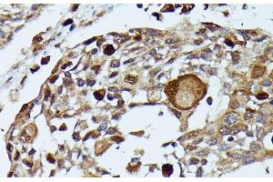 Immunohistochemistry of paraffin-embedded Human esophageal cancer using MAP3K3 Polyclonal Antibody at dilution of 1:100 (40x lens). (MAP3K3 antibody)