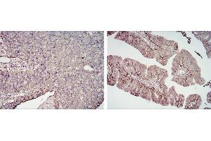 Immunohistochemical analysis of paraffin-embedded cervical cancer tissues (left) and ovarian cancer tissues (right) using CD276 mouse mAb with DAB staining.