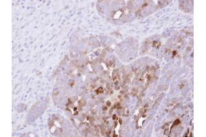 IHC-P Image Immunohistochemical analysis of paraffin-embedded NCIN87 xenograft , using PAI-2, antibody at 1:500 dilution. (SERPINB2 antibody  (Center))