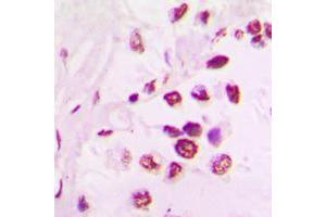 Immunohistochemical analysis of TEL staining in human lung cancer formalin fixed paraffin embedded tissue section. (ETV6 antibody  (C-Term))