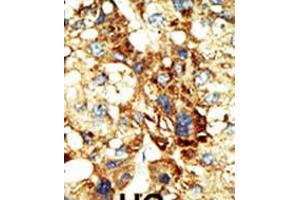 Formalin-fixed and paraffin-embedded human cancer tissue reacted with the primary antibody, which was peroxidase-conjugated to the secondary antibody, followed by DAB staining. (DNMT3A antibody  (AA 457-486))