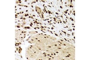 Immunohistochemistry of paraffin-embedded human gastric cancer using ANP32A Antibody (ABIN5973390) at dilution of 1/100 (40x lens). (PHAP1 antibody)