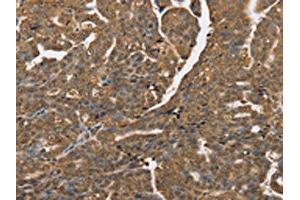The image on the left is immunohistochemistry of paraffin-embedded Human cervical cancer tissue using ABIN7192064(PTPN20A/PTPN20B Antibody) at dilution 1/40, on the right is treated with synthetic peptide. (PTPN2 antibody)