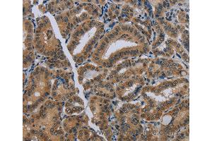 Immunohistochemistry of Human thyroid cancer using NAT10 Polyclonal Antibody at dilution of 1:40 (NAT10 antibody)