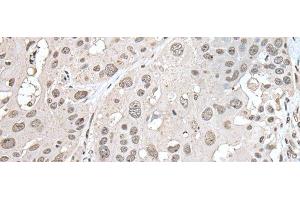 Immunohistochemistry of paraffin-embedded Human esophagus cancer tissue using VRK1 Polyclonal Antibody at dilution of 1:30(x200) (VRK1 antibody)