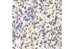 Immunohistochemistry of paraffin-embedded human kidney cancer using CENPC antibody at dilution of 1:200 (400x lens).
