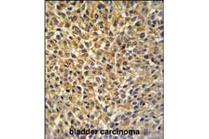 CRIP1 Antibody IHC analysis in formalin fixed and paraffin embedded bladder carcinoma followed by peroxidase conjugation of the secondary antibody and DAB staining. (CRIP1 antibody  (C-Term))