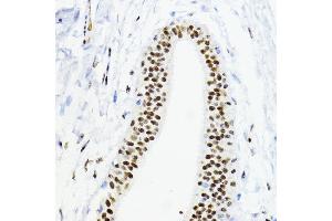 Immunohistochemistry of paraffin-embedded human mammary cancer using ZEB1 antibody (ABIN6129933, ABIN6150422, ABIN6150423 and ABIN6221237) at dilution of 1:200 (40x lens). (ZEB1 antibody  (AA 1-260))