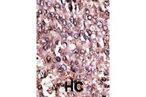 Formalin-fixed and paraffin-embedded human hepatocellular carcinoma tissue reacted with MAGEC1 polyclonal antibody  , which was peroxidase-conjugated to the secondary antibody, followed by AEC staining. (MAGEC1 antibody  (C-Term))