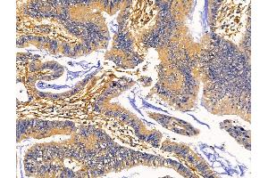 ABIN7093127 and ABIN7098695 at 1/100 staining Human colorectal cancer by IHC-P. (Clca3 antibody)