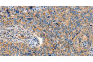 Immunohistochemistry of paraffin-embedded Human cervical cancer tissue using ADAMTS18 Polyclonal Antibody at dilution 1:30 (ADAMTS18 antibody)