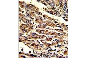 Formalin-fixed and paraffin-embedded human hepatocarcinoma with HOMER1 Antibody (N-term), which was peroxidase-conjugated to the secondary antibody, followed by DAB staining. (HOMER1 antibody  (N-Term))