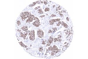 Breast Breast cancer of no special type NST showing moderate to strong GATA3 immunostaining (GATA3 antibody)