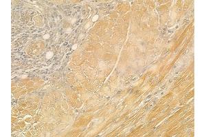 ABIN6260540 and ABIN6276944 at 1/100 staining human tongue carcinoma by IHC-P.