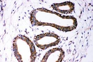 IHC-P: Dicer antibody testing of human breast cancer tissue (DICER1 antibody  (AA 1-195))