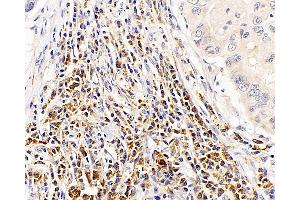 Immunohistochemistry analysis of paraffin-embedded human lung cancer using CASP1 Polyclonal Antibody at dilution of 1:300. (Caspase 1 antibody)