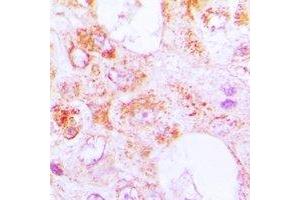 Immunohistochemical analysis of Centrin-3 staining in human lung cancer formalin fixed paraffin embedded tissue section. (CETN3 antibody)