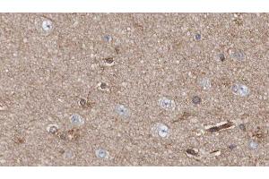 ABIN6279117 at 1/100 staining Human brain cancer tissue by IHC-P. (APBA2 antibody  (Internal Region))