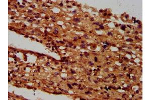 IHC image of ABIN7145527 diluted at 1:600 and staining in paraffin-embedded human melanoma performed on a Leica BondTM system. (SGCB antibody  (AA 124-219))