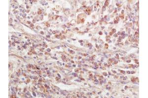 Formalin-fixed and paraffin embedded human lung carcinoma labeled with Rabbit Anti-EPS15R Polyclonal Antibody, Unconjugated  at 1:200 followed by conjugation to the secondary antibody and DAB staining (EPS15L1 antibody  (AA 275-380))