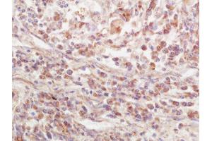 Formalin-fixed and paraffin embedded human lung carcinoma labeled with Rabbit Anti-EPS15R Polyclonal Antibody, Unconjugated  at 1:200 followed by conjugation to the secondary antibody and DAB staining (EPS15L1 antibody  (AA 275-380))