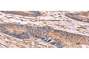 Immunohistochemistry of paraffin-embedded Human colorectal cancer tissue using KCNN2 Polyclonal Antibody at dilution of 1:65(x200) (KCNN2 antibody)