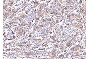 ABIN6275240 at 1/100 staining Human breast cancer tissue by IHC-P. (SLC25A21 antibody  (Internal Region))