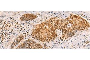Immunohistochemistry of paraffin-embedded Human esophagus cancer tissue using SREBF2 Polyclonal Antibody at dilution of 1:50(x200) (SREBF2 antibody)