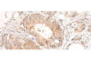 Immunohistochemistry of paraffin-embedded Human colorectal cancer tissue using HTRA1 Polyclonal Antibody at dilution of 1:55(x200) (HTRA1 antibody)