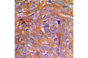Immunohistochemical analysis of Caspase 8 (pS347) staining in human breast cancer formalin fixed paraffin embedded tissue section. (Caspase 8 antibody  (pSer347))
