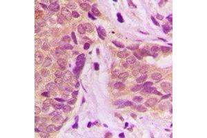 Immunohistochemical analysis of GSTP1 staining in human breast cancer formalin fixed paraffin embedded tissue section. (GSTP1 antibody)