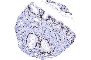 Uterus endocervix Strong PR immunostaining in epithelial and stromal cells of the endocervix (Recombinant Progesterone Receptor antibody  (AA 1-200))