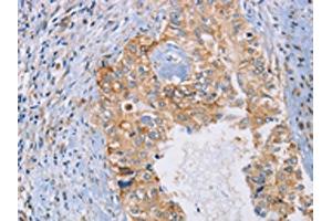 The image on the left is immunohistochemistry of paraffin-embedded Human cervical cancer tissue using ABIN7192619(SPAG6 Antibody) at dilution 1/30, on the right is treated with synthetic peptide. (SPAG6 antibody)